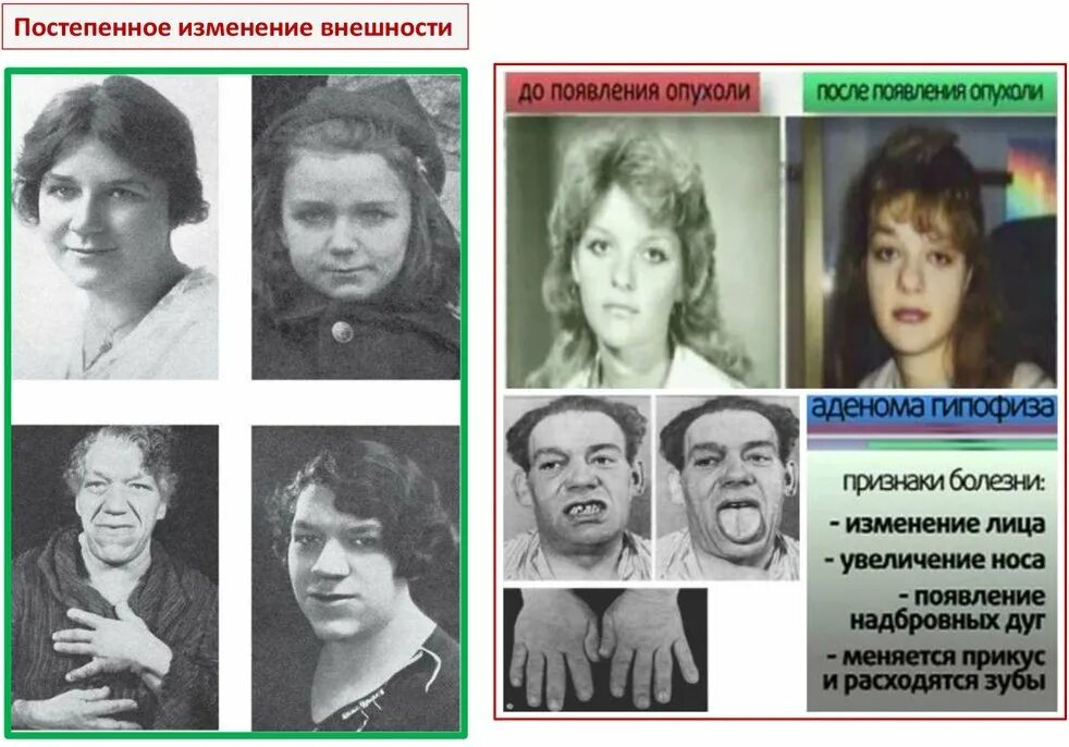 Гипофиза симптомы у женщин лечение прогноз. Опухоль гипофиза симптомы. опухоль гипофиза симптомы у женщин. аденома гипофиза симптомы. аденома гипофиза симптомы у женщин симптомы.