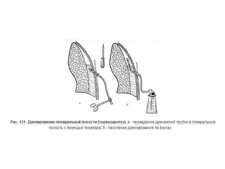 Плевральная пункция торакоцентез. Троакар для пункции плевральной полости. Методика дренирования плевральной полости. Показания к дренированию плевральной полости.