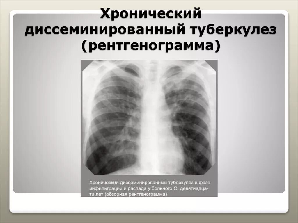 Диссеминированный туберкулез легких фазы. Подострый диссеминированный туберкулез рентген. Диссеминированный туберкулез на кт. Диссеминированный туберкулез на рентгенограмме. Хронический диссеминированный туберкулез.