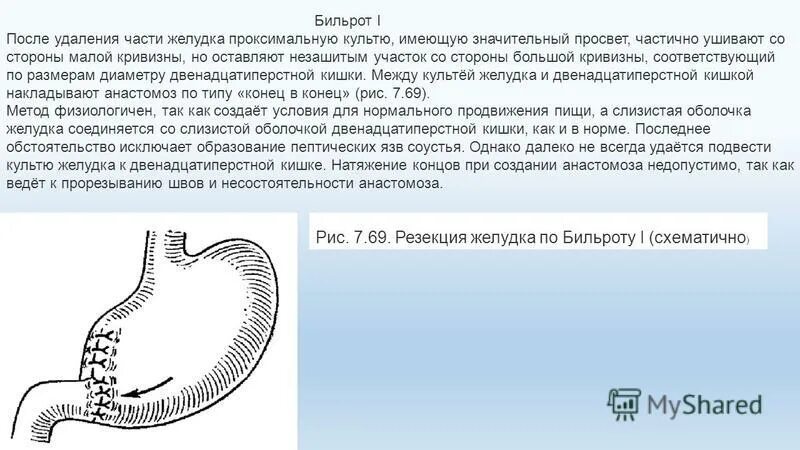 Резекция желудка инвалидность. Дита после резекциижелудка. после резекции желудка. питание после резекции желудка. диета после гастрэктомии желудка.