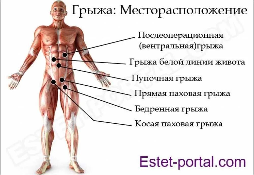 Симптомы грыжи живота у женщин слева. Какие виды грыжи существует. Места возникновения грыж.