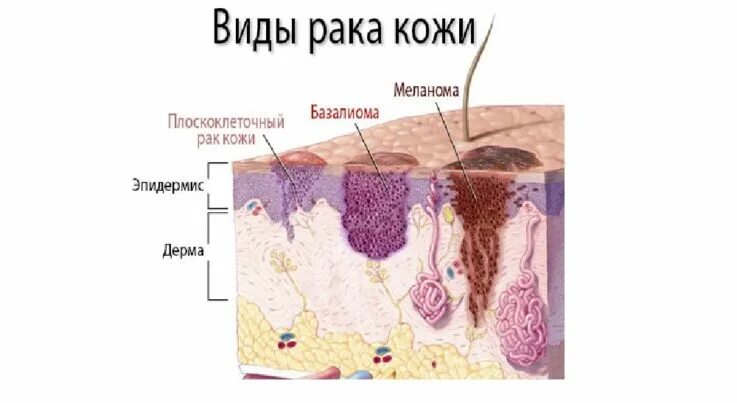 плотный проникнуть. тромбированный узел геморрой. липома доброкачественная опухоль жировой ткани. влагалище изнутри в разрезе. введение пигмента в кожу.
