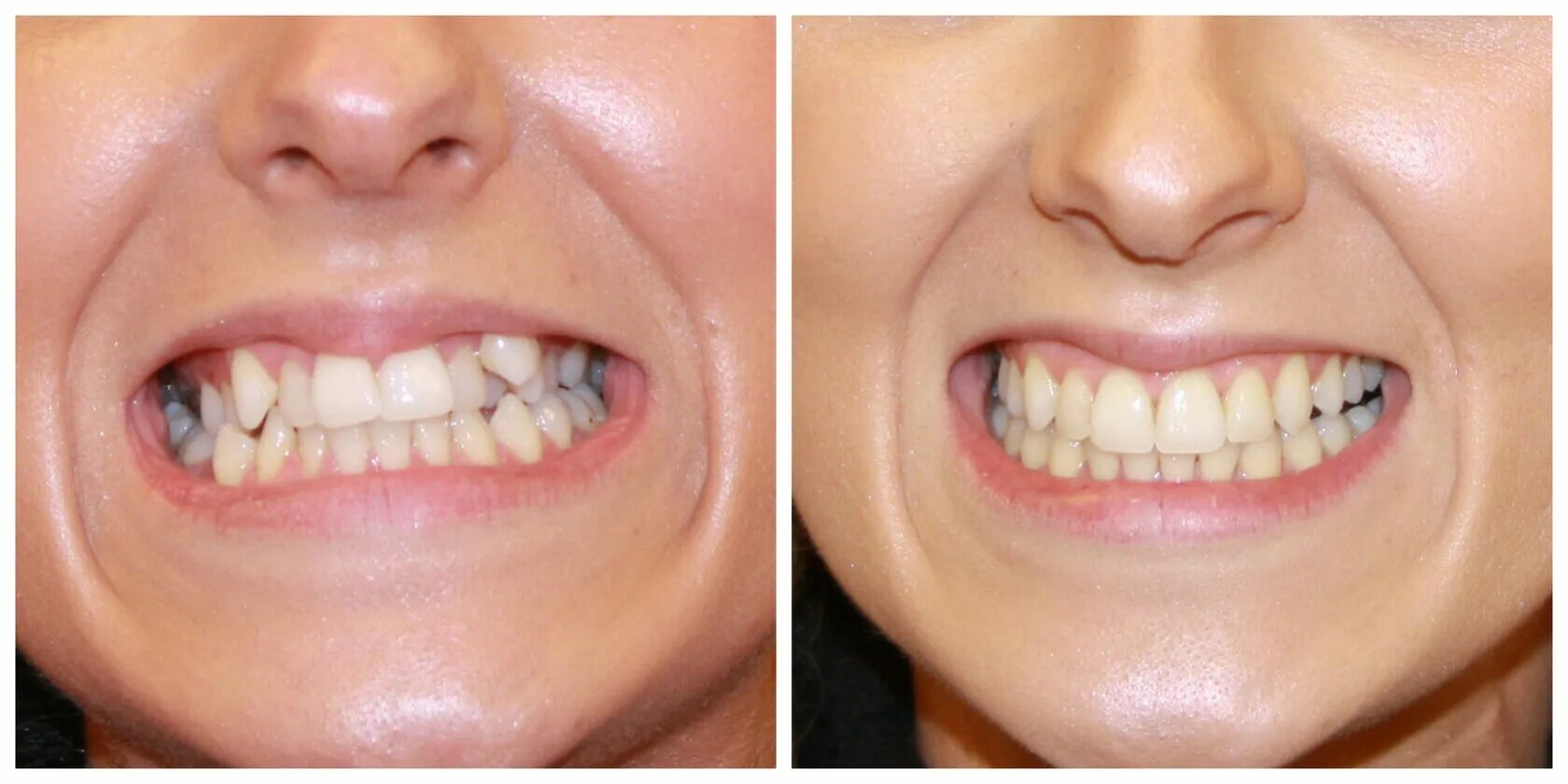 передние зубы смена