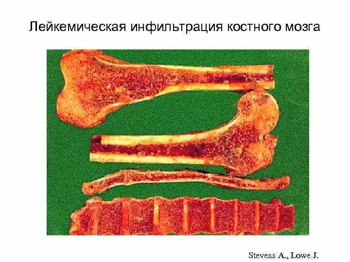 Диффузное изменение костного мозга. Диффузное изменение костного мозга