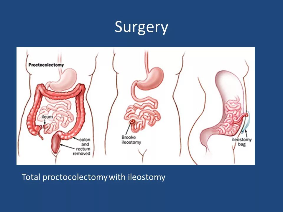 Колэктомия это. Субтотальная колэктомия. Субтотальная колэктомия операция. Тотальная проктоколэктомия.