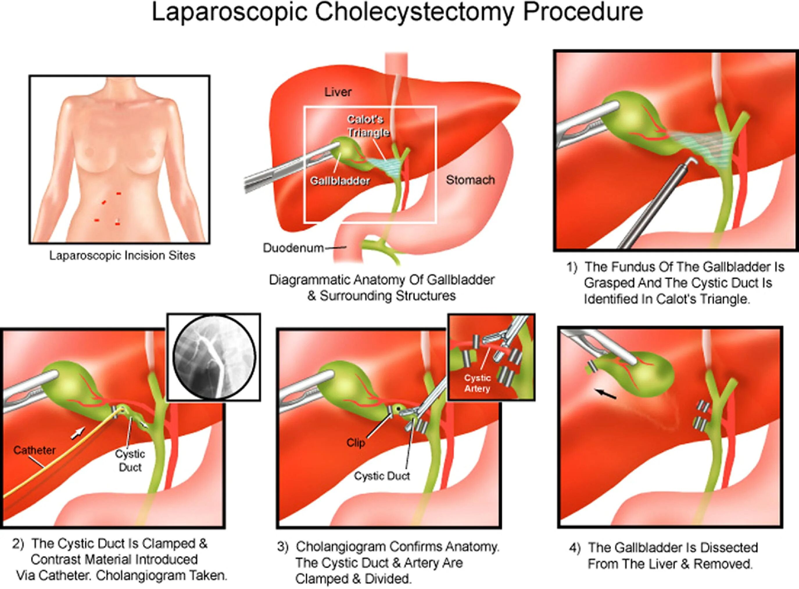 Катетер желчного пузыря. Холецистэктомия от дна и от шейки. Операция холецистэктомия ход операции. Холецистэктомия желчного пузыря лапароскопическая. Лапароскопическая холецистэктомия этапы операции.