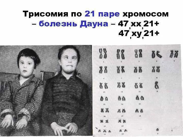 Сколько хромосом у людей с синдромом дауна. Трисомия по 21 хромосоме. Синдром Дауна трисомия 21 хромосомы. НУЛИСОМИЯ по 21 хромосоме. Синдром трисомии по 21 паре хромосом.