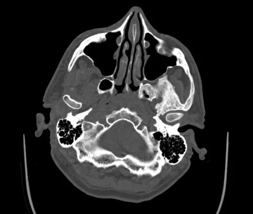 Остеома решетчатой кости кт. Гемангиома клиновидной кости на кт. Остеома клиновидной кости на кт. Остеома клеток решетчатого Лабиринта кт.
