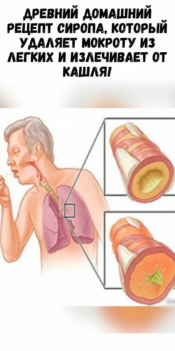 Убрать мокроту в домашних условиях. Вывод мокроты из бронхов и легких. Как быстро избавиться от мокроты. Вывод мокроты из лёгких. Выведение мокроты и слизи из легких.