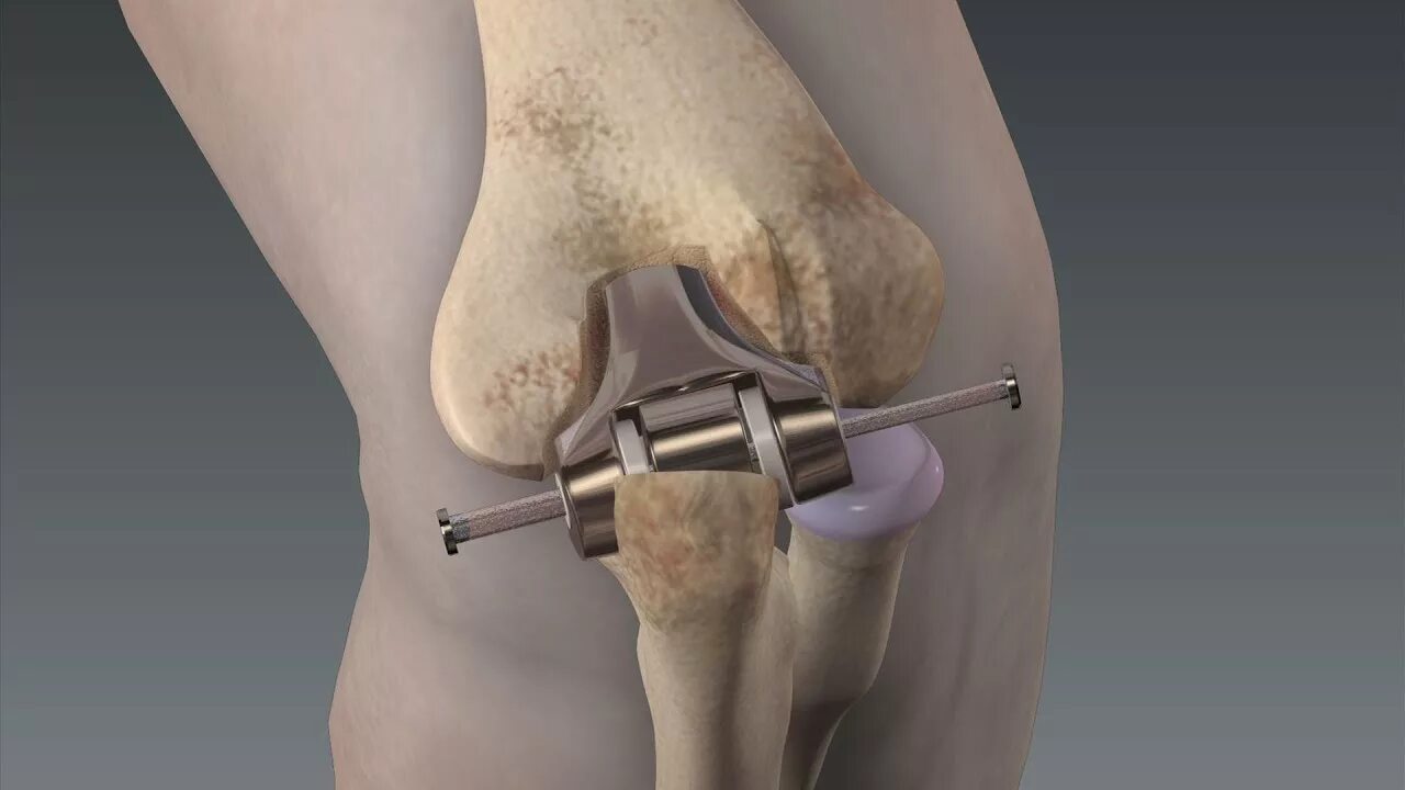 Elbow Replacement - Mayo Clinic - YouTube