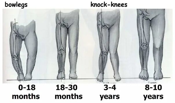 Flat feet