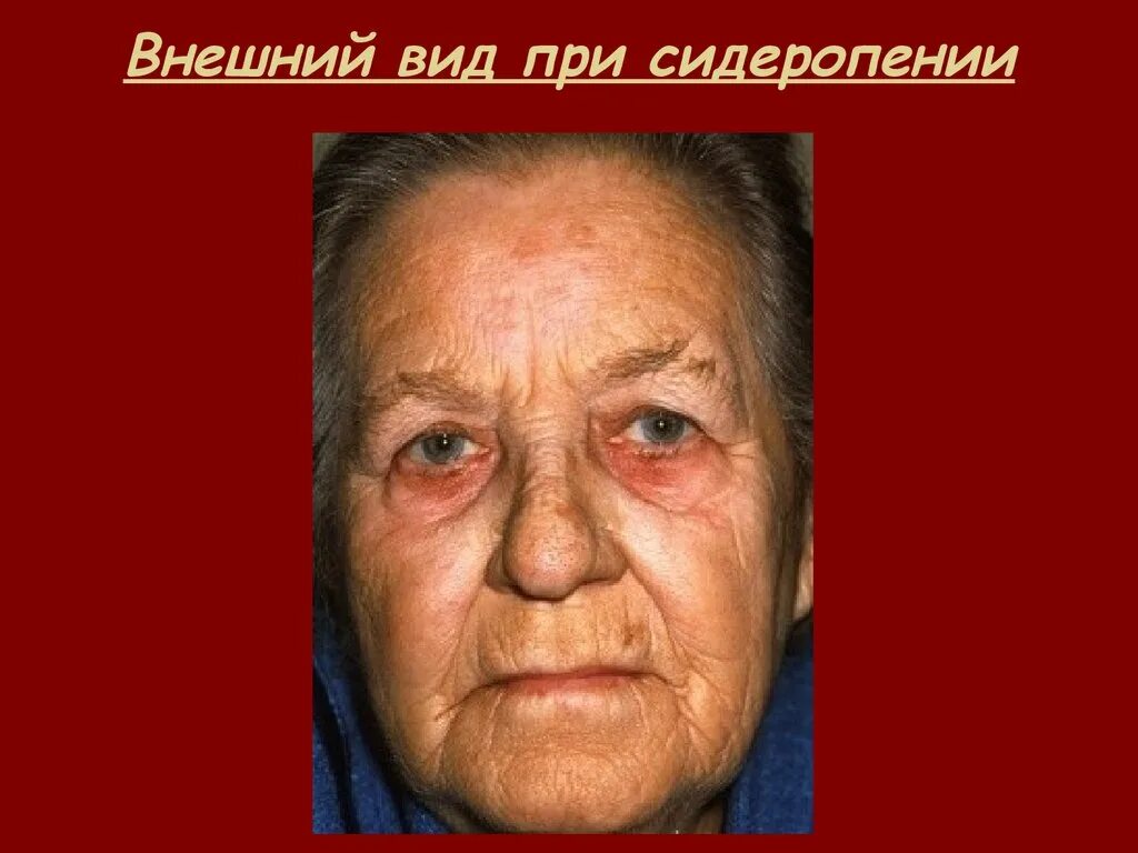 Кожные покровы при железодефицитной. Кожные изменения при анемии. кожные покровы при анемии.