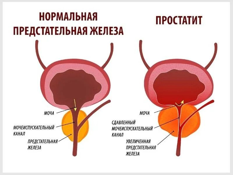 Чувствительность простаты