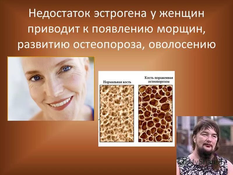 Заболевания при избытке эстрогенов. Низкий уровень половых гормонов. Признаки нехватки эстрогена. Симптрмыидефицина эстрогенов. Снижение уровня эстрогенов.