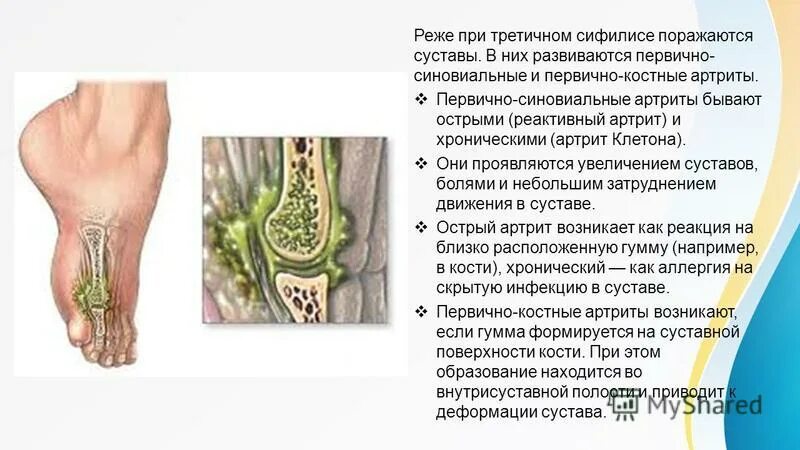 Как выглядит сифилис на ногах Mst: Contre La Résistance Aux Antibiotiques, L'oms Préconise Des FC2