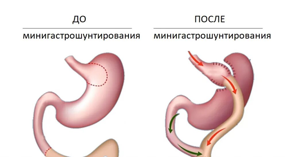 Резекция и шунтирование желудка разница. Желудочное шунтирование. мини гастрошунтирование. билиопанкреатическое шунтирование желудка что это.