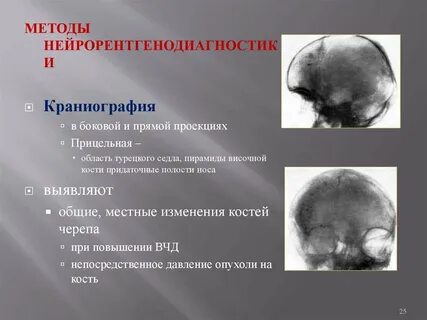 Опухоль височно