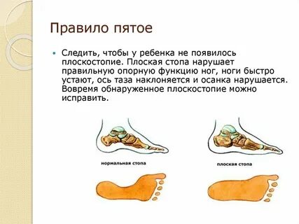 Почему появляется плоскостопие москва