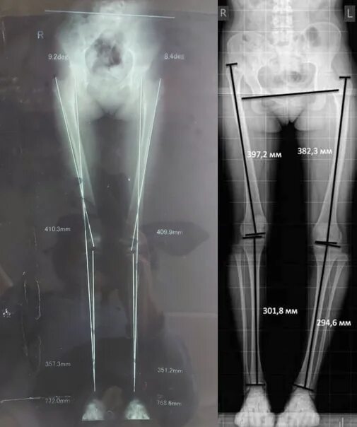 Рентген телеметрия нижних конечностей сшивка. Панорамная рентгенограмма нижних конечностей. Рентгеновский снимок нижних конечностей. Обзорный рентген нижних конечностей.