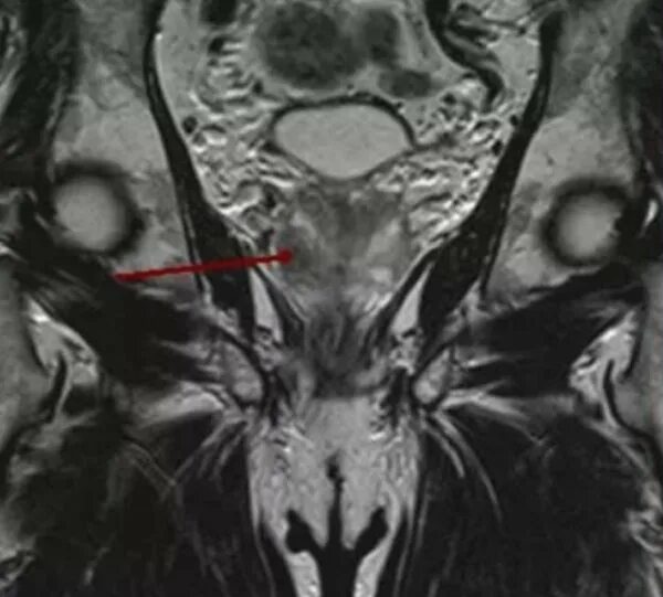 Кт малого таза с контрастом у мужчин. Спаечная болезнь малого таза мрт. Карцинома малого таза мрт. Снимки мрт предстательная железа.
