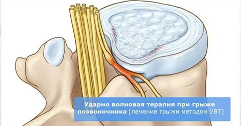 Где лечат грыжу