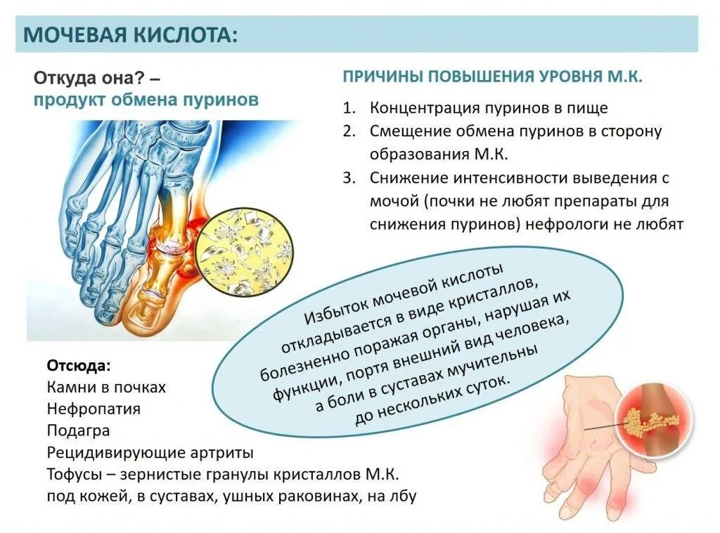 Мочевая кислота как проявляется. Мочевая кислота как проявляется