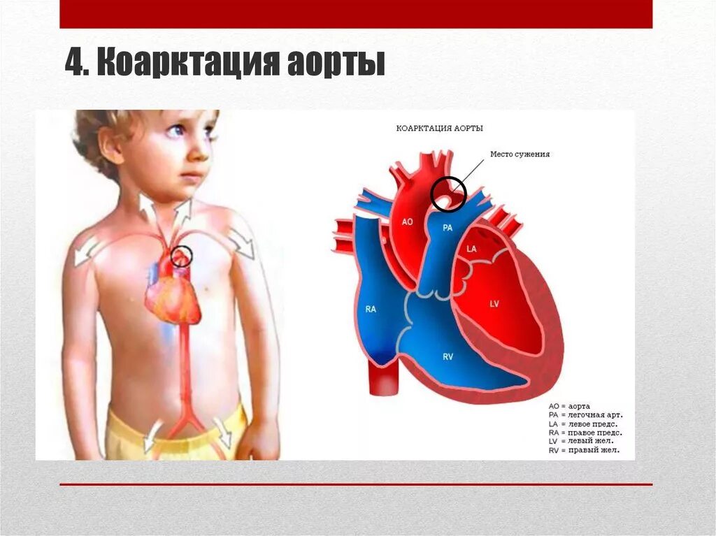 Коарктация аорты у новорожденных