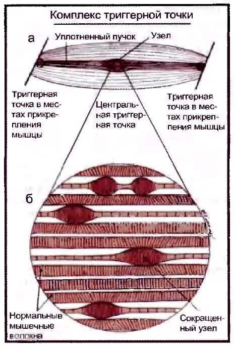 Триггерные точки это простыми словами. Триггерные точки фасции. Триггерная точка в мышцах. Мышечные триггерные точки. Строение триггерной точки.