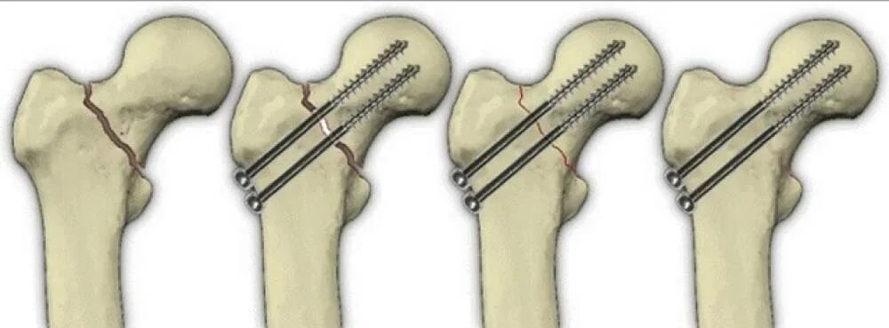 Интрамедуллярный остеосинтез шейки бедра гамма. Остеосинтез перелома шейки бедра канюлированными винтами. Перелом шейки бедра остеосинтез рентген. Остеосинтез 3 канюлированными винтами шейки бедра. Шейка бедра лечение без операции