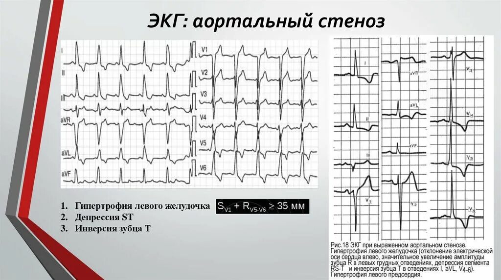 Показывает ли экг сердечную недостаточность. Экг при аортальном пороке сердца. аортальный стеноз экг. стеноз митрального клапана экг. экг при пороках митрального клапана.