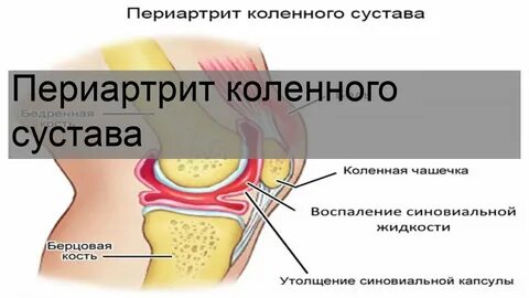 Периартрит что это