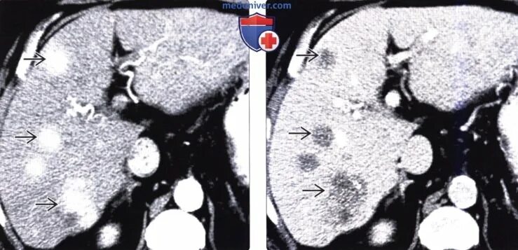 Гиперваскулярные метастазы печени кт. Гиповаскулярные метастазы печени кт. Гиперперфузия печени на кт. Гиперваскулярные очаги печени при кт. Гиперваскулярное образование печени
