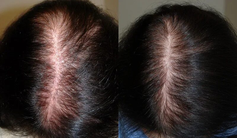 Андрогенная алопеция трихоскопия. Дарсонваль алопеция до после. Мезотерапия волос до и после. После лучевой волосы выпадают