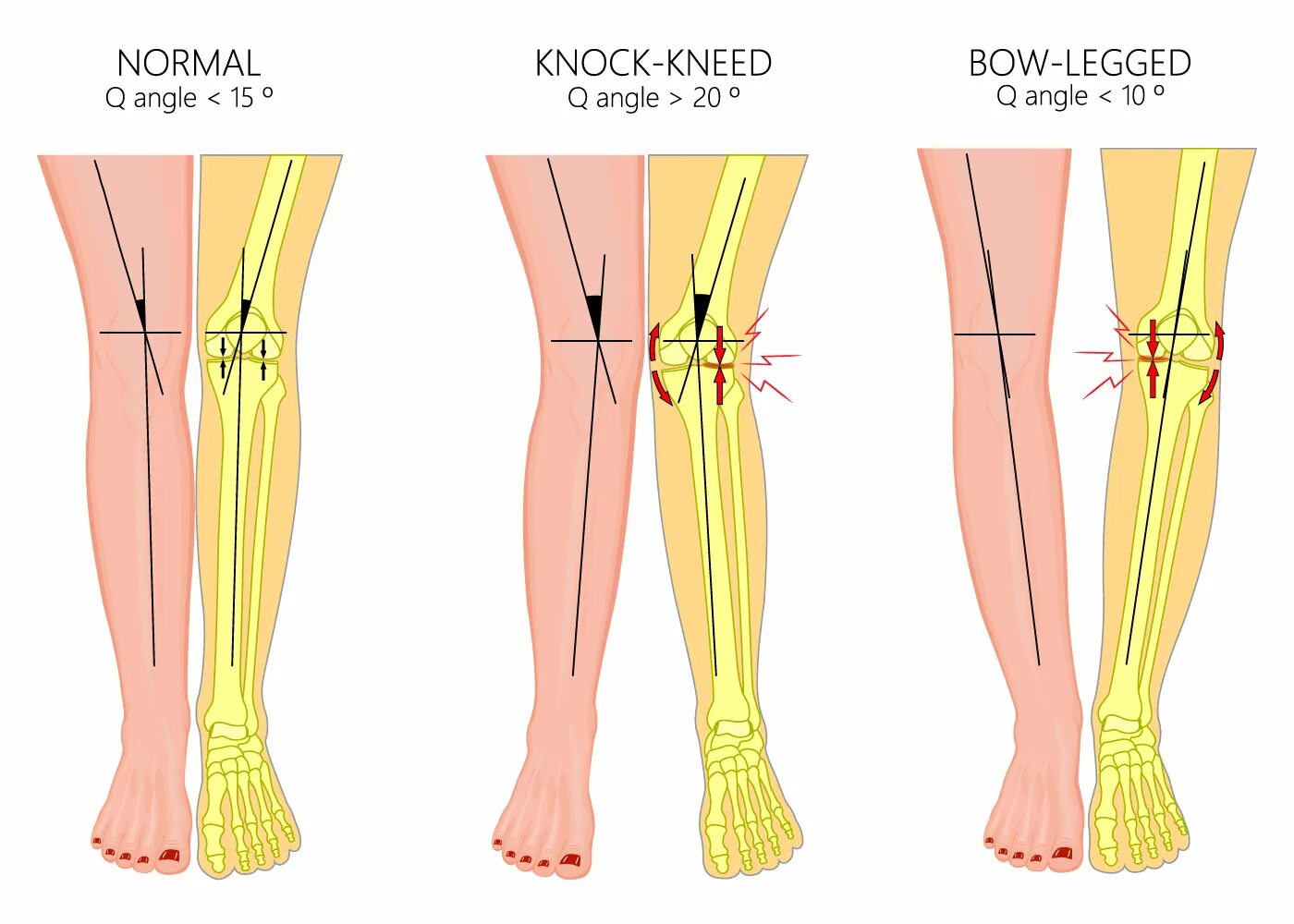 Колено стучит. Форма ног. Идеальная форма ног. Форма ног у женщин Knock Kneed.