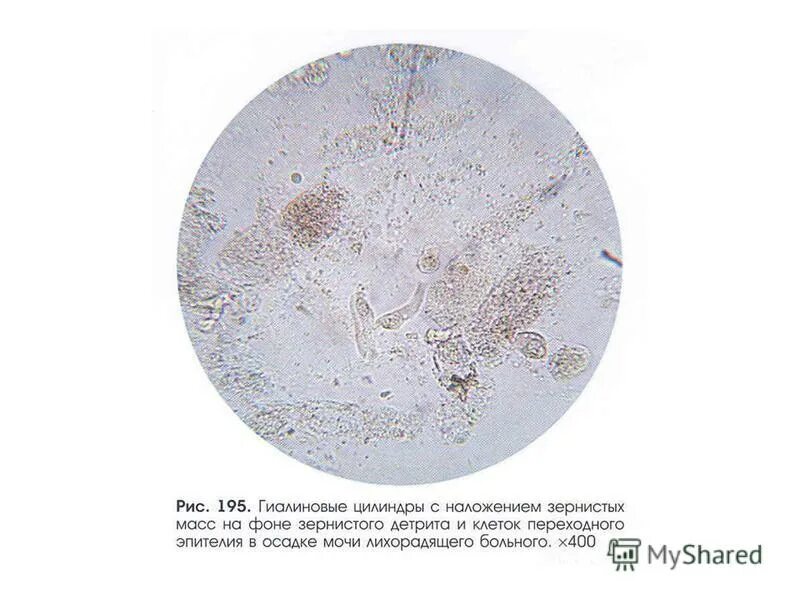 Моча цилиндры гиалиновые повышенные. Нечипоренко микроскопия. Гиалиновый цилиндр в моче микроскопия. Гиалиновые и зернистые цилиндры в моче. Гиалиновые цилиндры под микроскопом.
