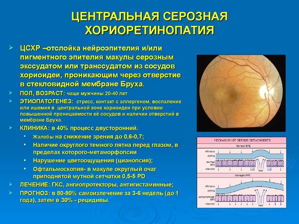 Серозная отслойка нейроэпителия. Центральная серозная ретинопатия. Центральная серозная ретинопатия глаза. Отслойка нейроэпителия сетчатки на окт.