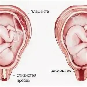 Слизистая пробка перед родами. СЛИЗИСЛИЗИСТАЯ пробка. Слизистая пробка беременность. Отошла слизистая пробка. 40 недель шейка не готова