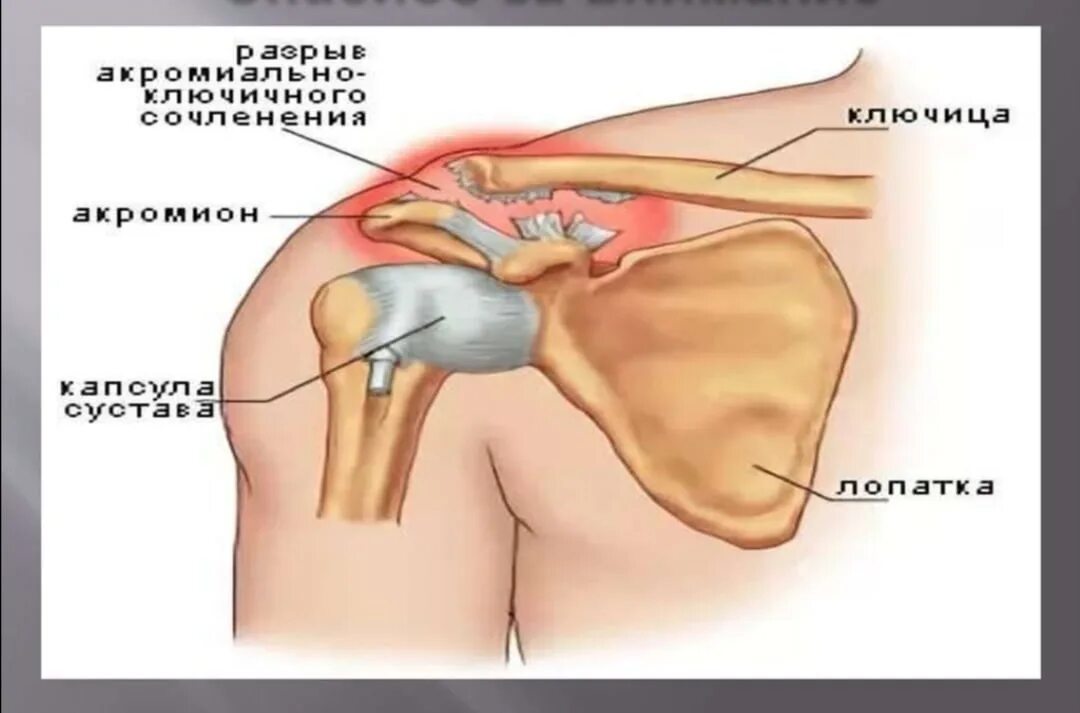 Лечение ключично акромиального артроза. Акромион сустав. Акромиально-Ключичная связка. Разрыву акромиально-ключичного сочленения ( Тип 1). Акс 2 ст плечевого сустава.
