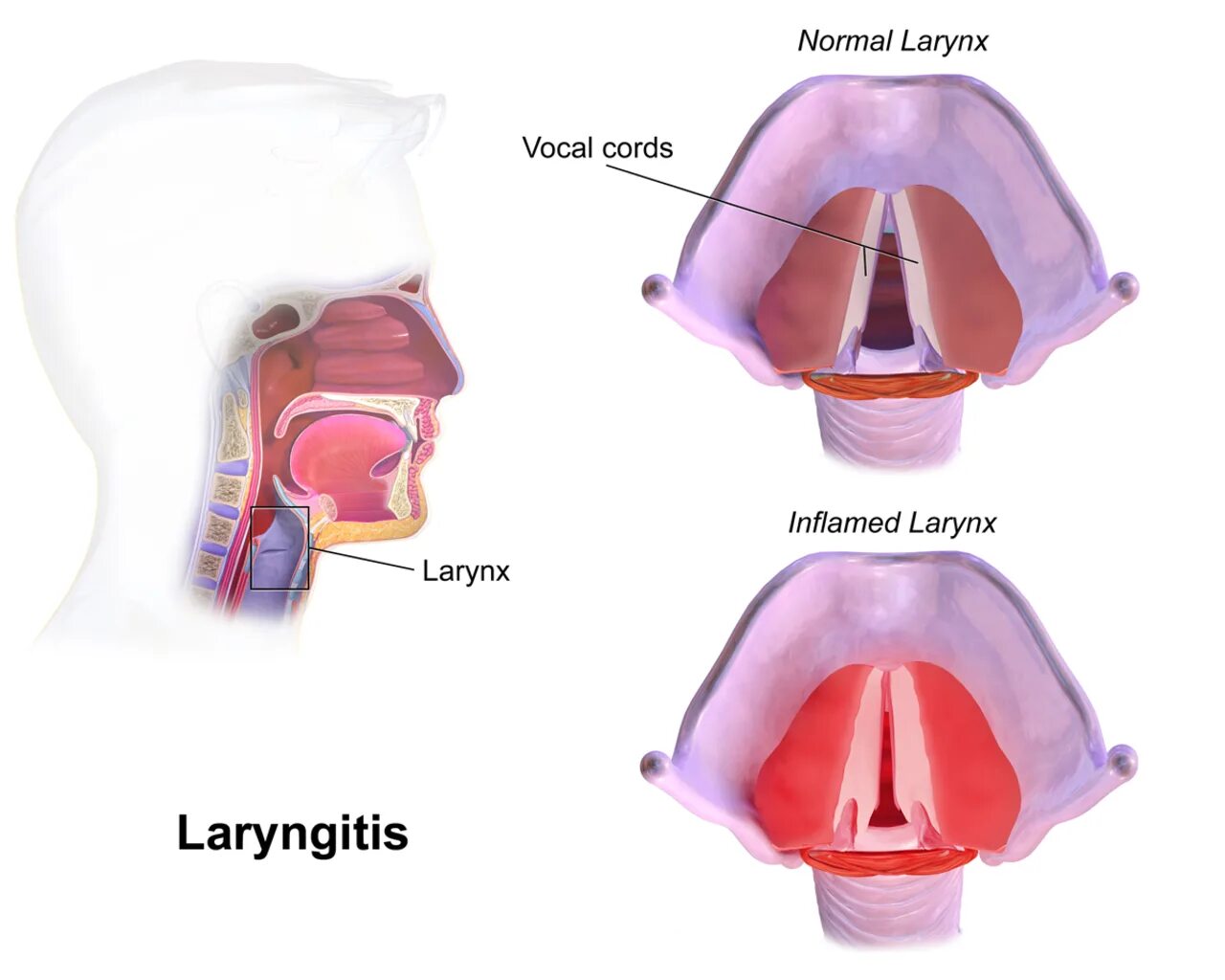 Воспаление надгортанника. Надгортанник воспален. Голосовые связки ларингит. Ларингит это отек голосовых связок.