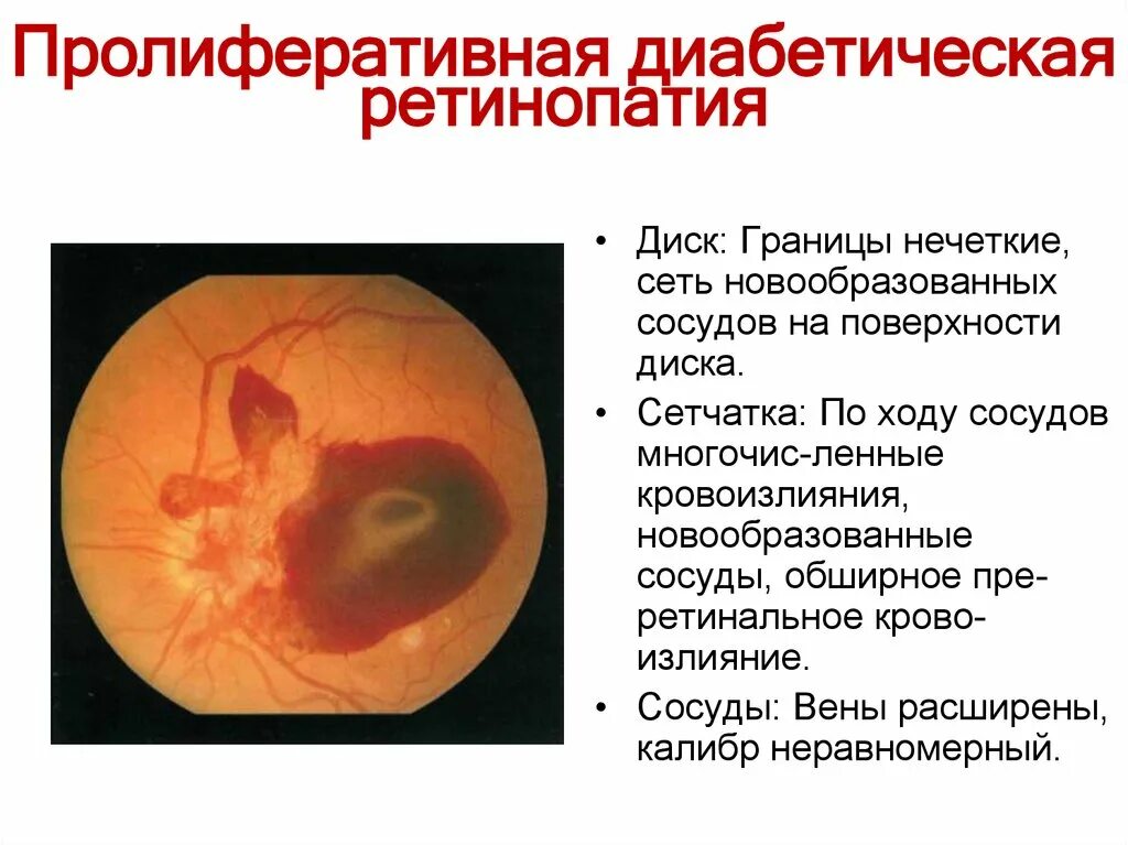 Непролиферативная диабетическая ретинопатия классификация. Классификация диабетической ретинопатии патогенез. Препролиферативная диабетическая ретинопатия характеризуется:. Пролиферативная диабетическая ретинопатия характеризуется:. Классификация диабетической ретинопатии.