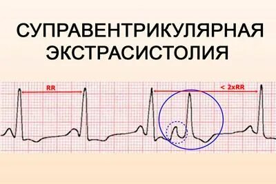 Нжэс в кардиологии