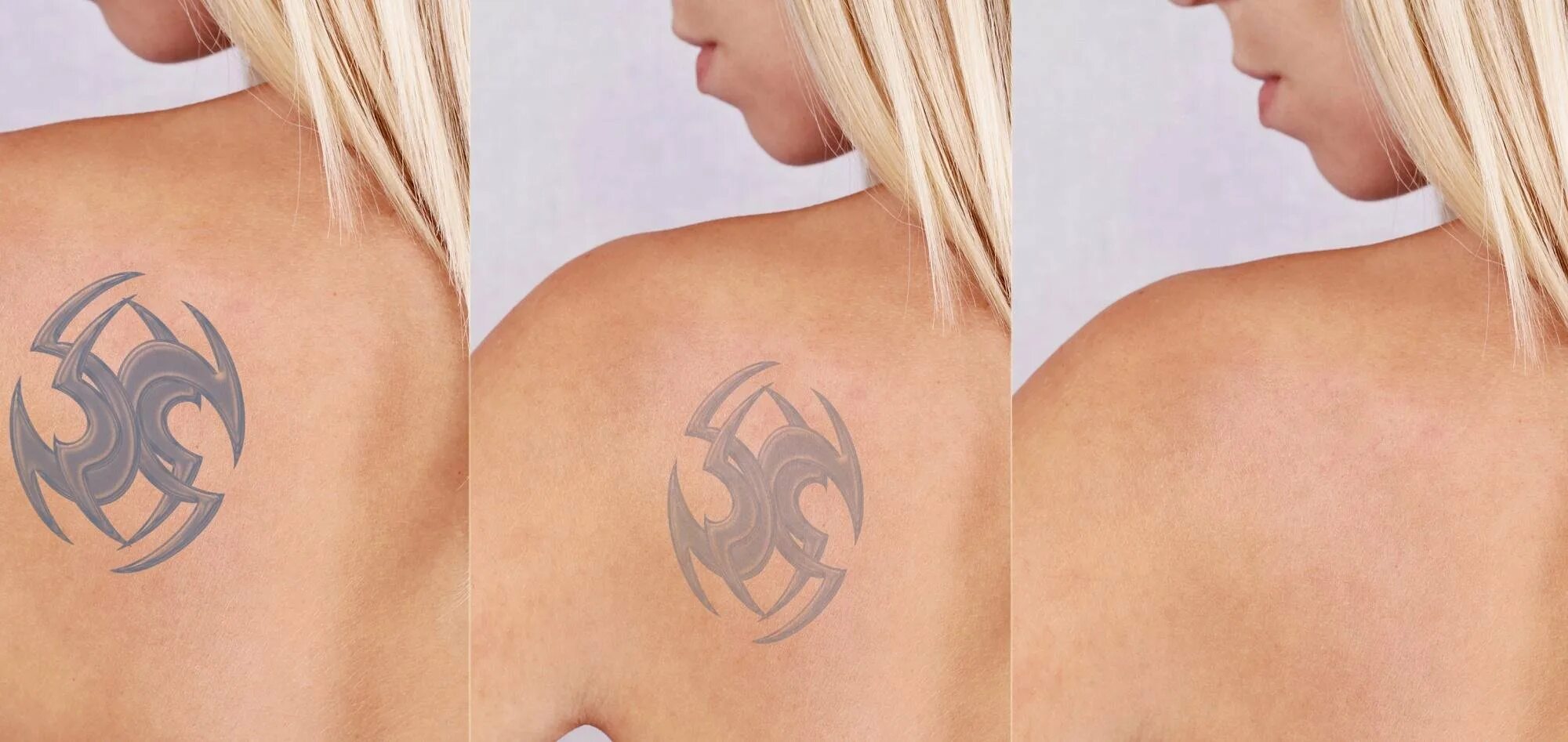 Как выглядит удаление тату. Выведение татуировок лазером. Выведение татуировок лазером. Сведение татуировки лазером. Как выглядит удаление тату.