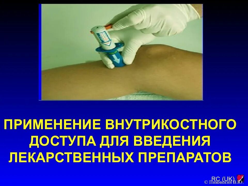 Внутрикостное введение лекарственных. Внутрикостная инъекция алгоритм. внутрикостное введение лекарственных средств. техника внутрикостного введения лекарственных средств.