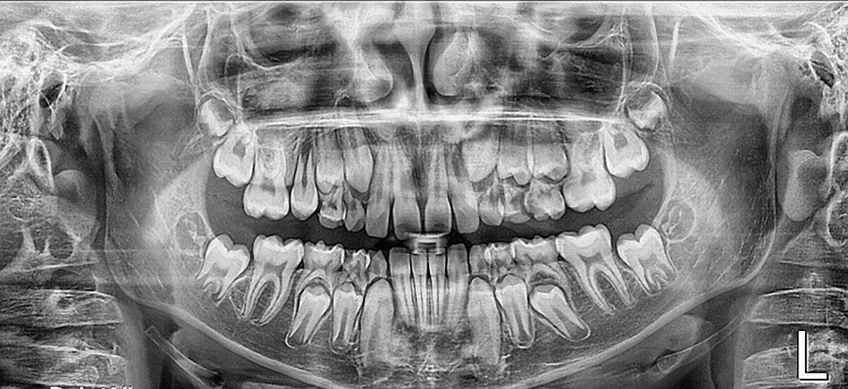 Детский череп рентген. Рентгенограмма сменного прикуса. Сменный прикус рентген.