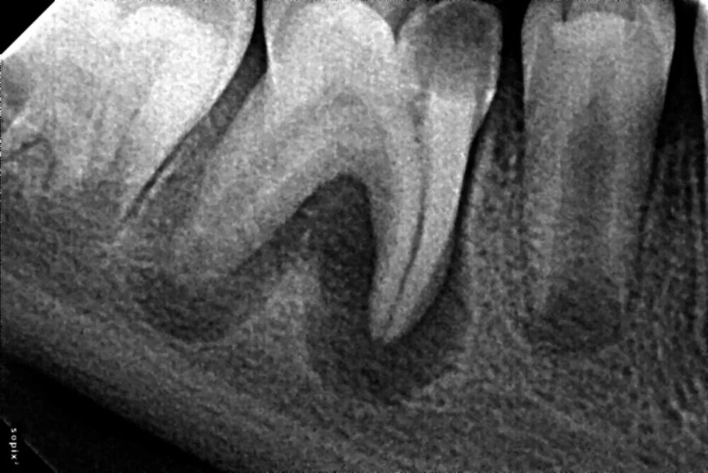 Воспаление канала зуба. Гранулематозный апикальный периодонтит. Хронический гранулирующий периодонтит рентген. Периодонтит фиброзный гранулематозный гранулирующий. Гранулематозный периодонтит рентген зуба.