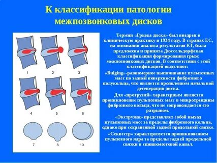 Какой размер грыжи считается большим