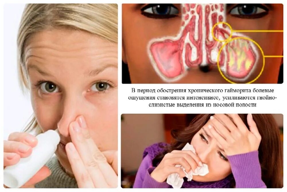 Гной из носа при гайморите. Какие сопли при синусите. Какие сопли при синусите. Какие сопли при синусите. Выделения из носа при гайморите.