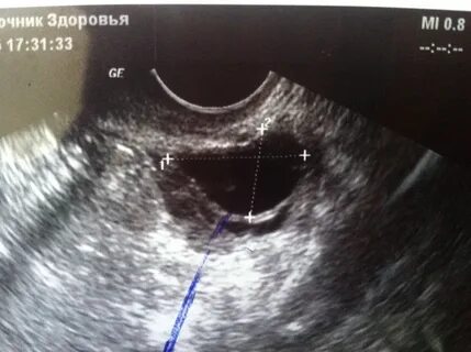 Узи фолликула что это