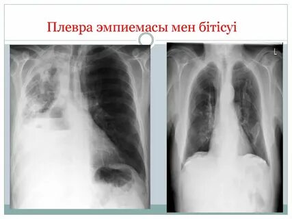 Пиоторакс с фистулой