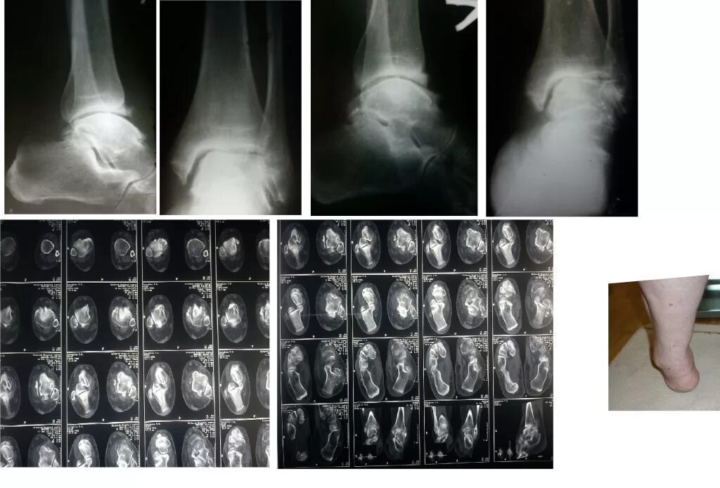 Деформирующий артроз голеностопа. Артроз 2 степени голеностопного сустава инвалидность. Деформирующий артроз голеностопного сустава рентген. Остеоартроз голеностопного сустава рентген. Деформирующий остеоартроз стопы рентген.